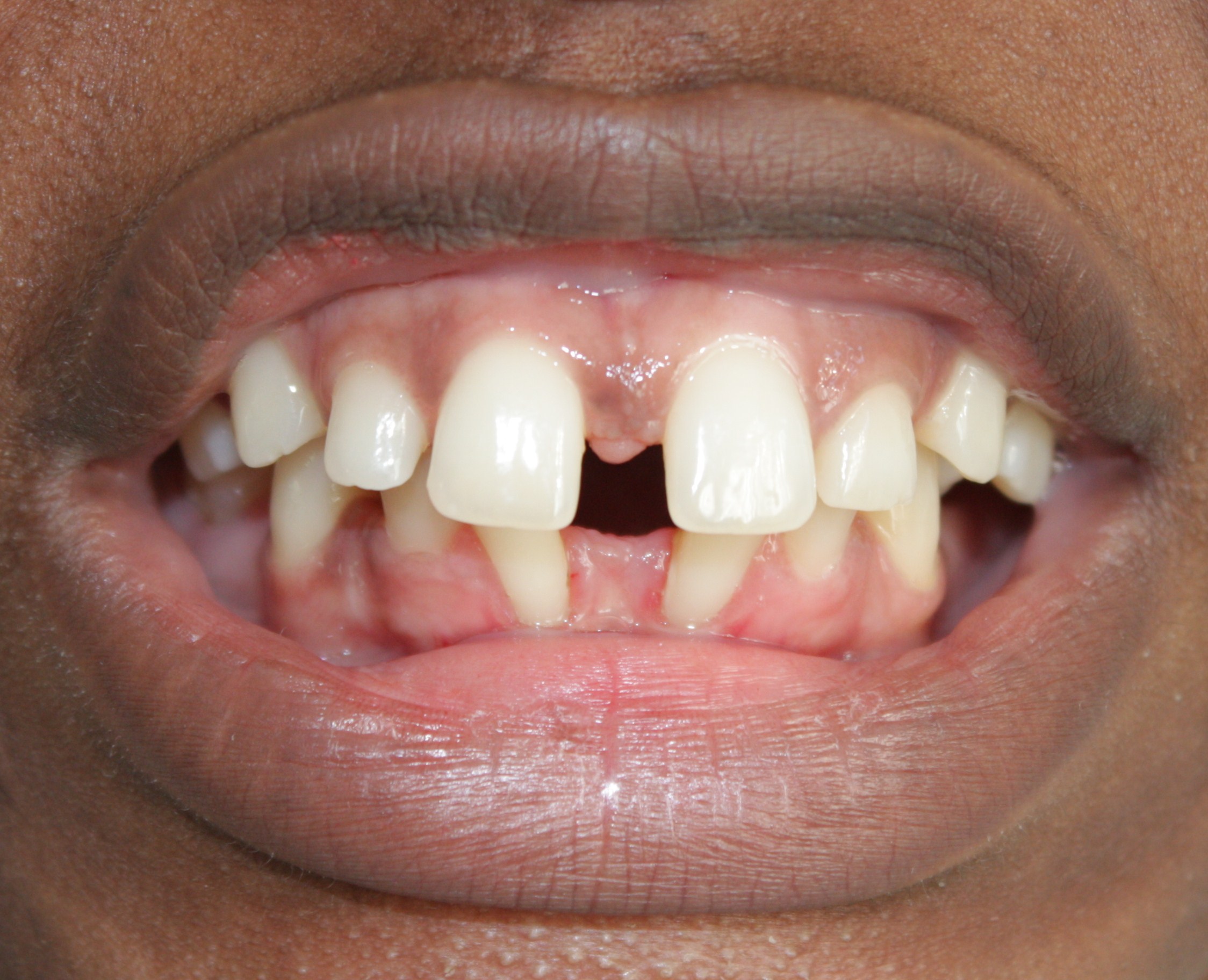 N_diastema-1.JPG