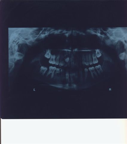agenesia dentale denti lateralis agenesia dentale denti lateralis