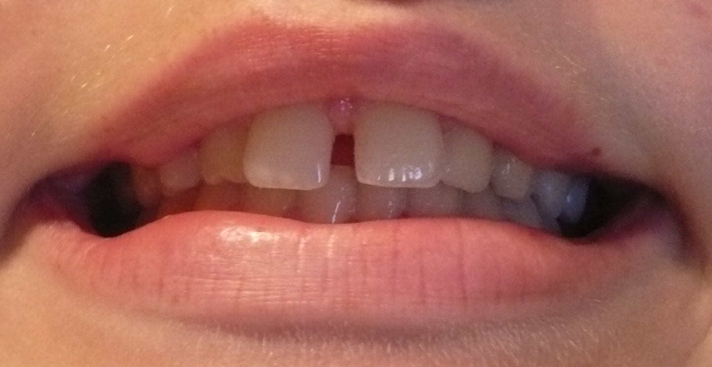 Diastema