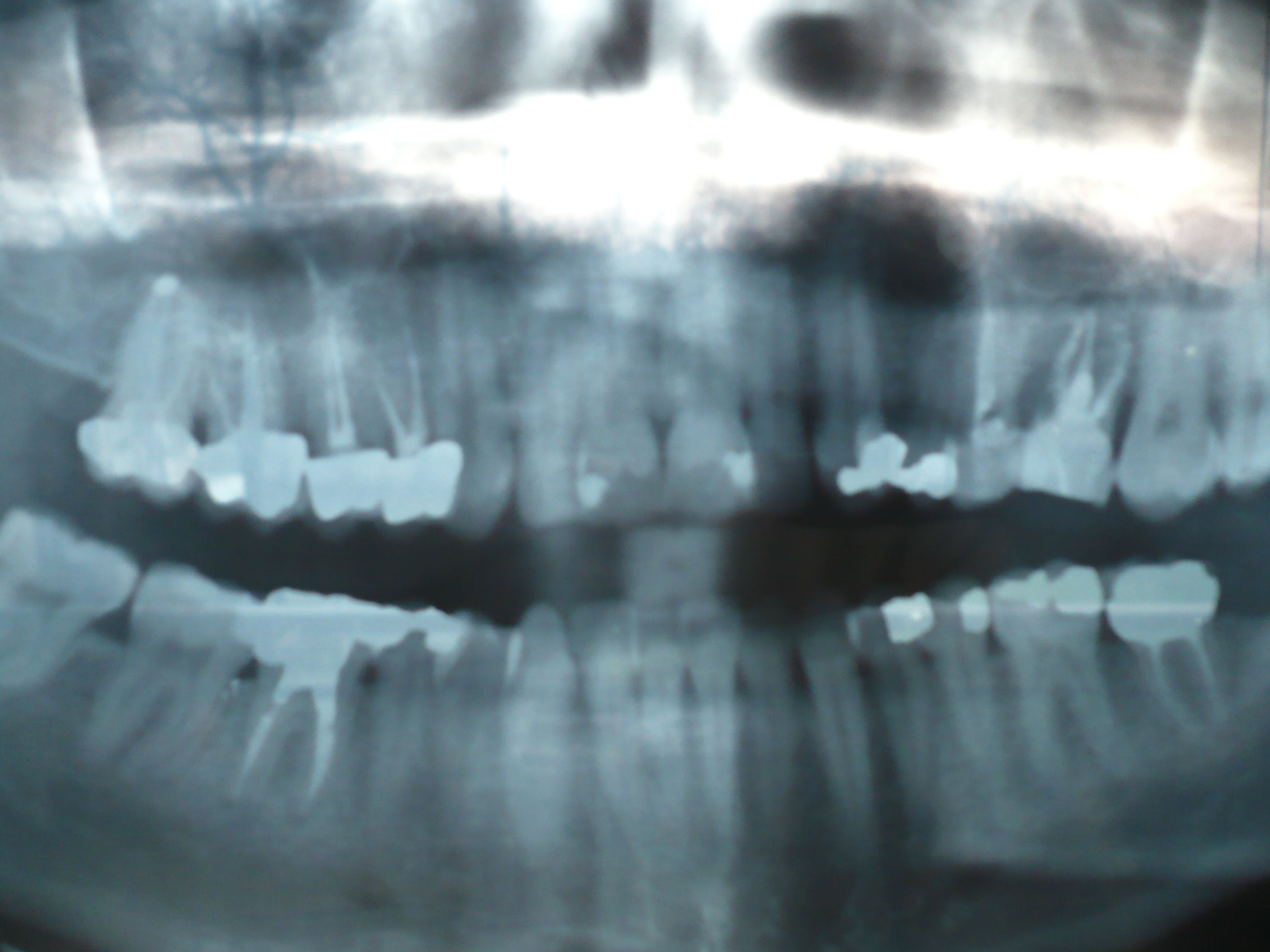 Panoramica-lastra-xray.JPG