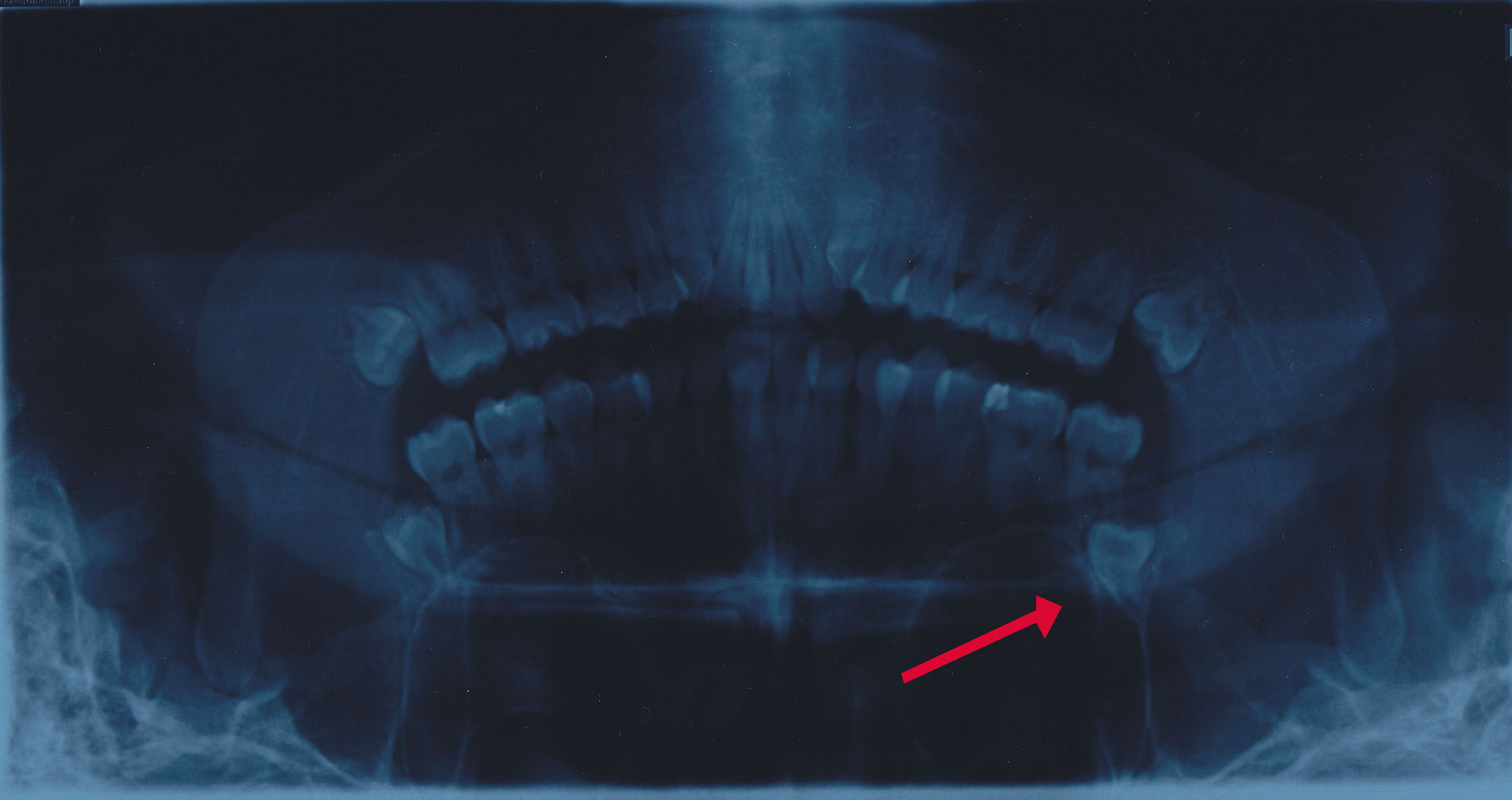E' possibile togliere il dente con un'operazione meno invasiva?