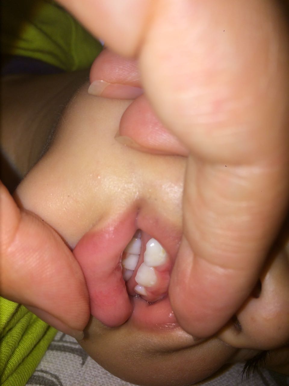 Mio figlio di 2 anni presenta delle macchie giallastre ai denti