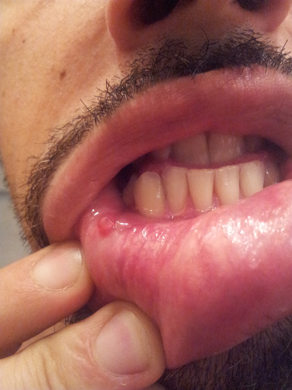 Papilloma vírus labbro
