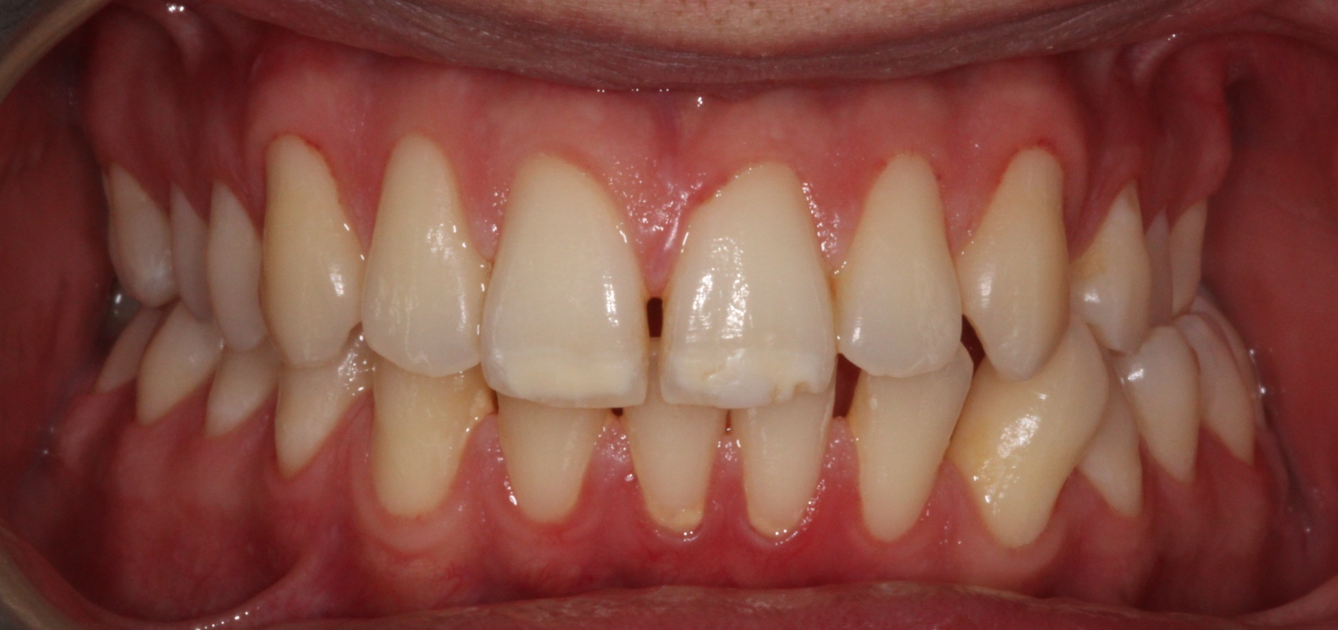 SEGUITO ALLA DOMANDA : MALOCCLUSIONE DI SECONDA CLASSE DENTALE PIÃ MORSO CROCIATO MONOLATERALE SINISTRO