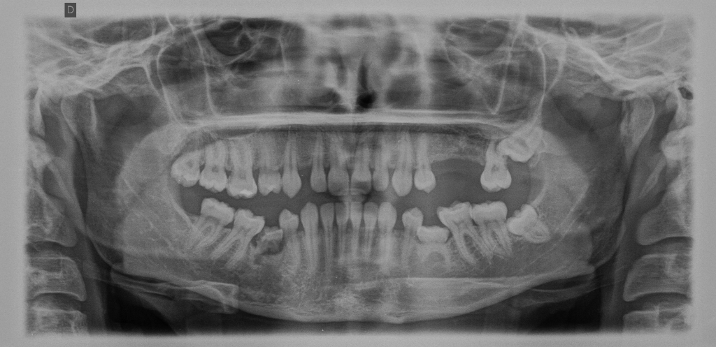 Nell'arcata inferiore mi sono rimasti altri due denti da latte