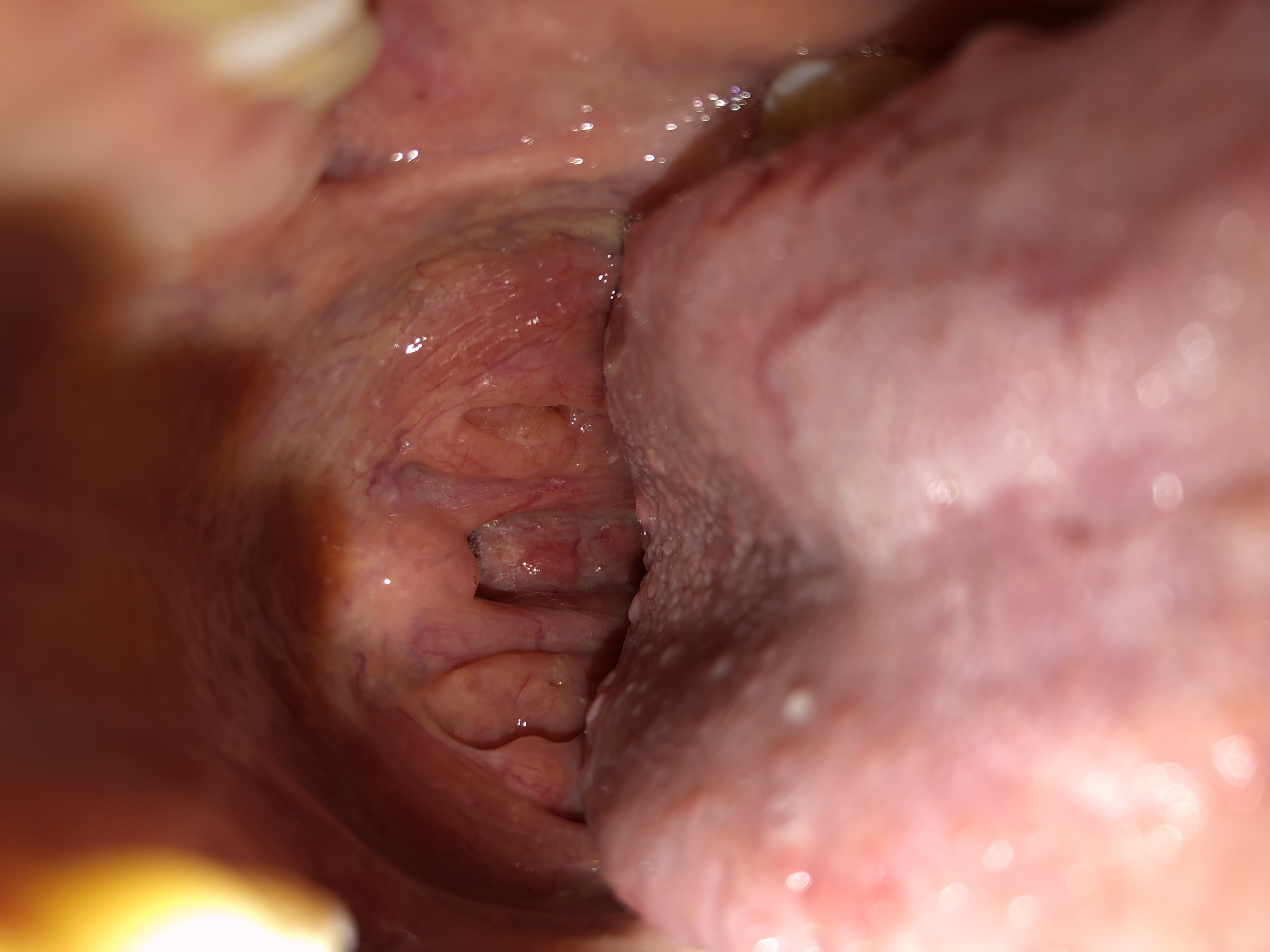 Lingua con puntini bianchi e rossi da due settimane