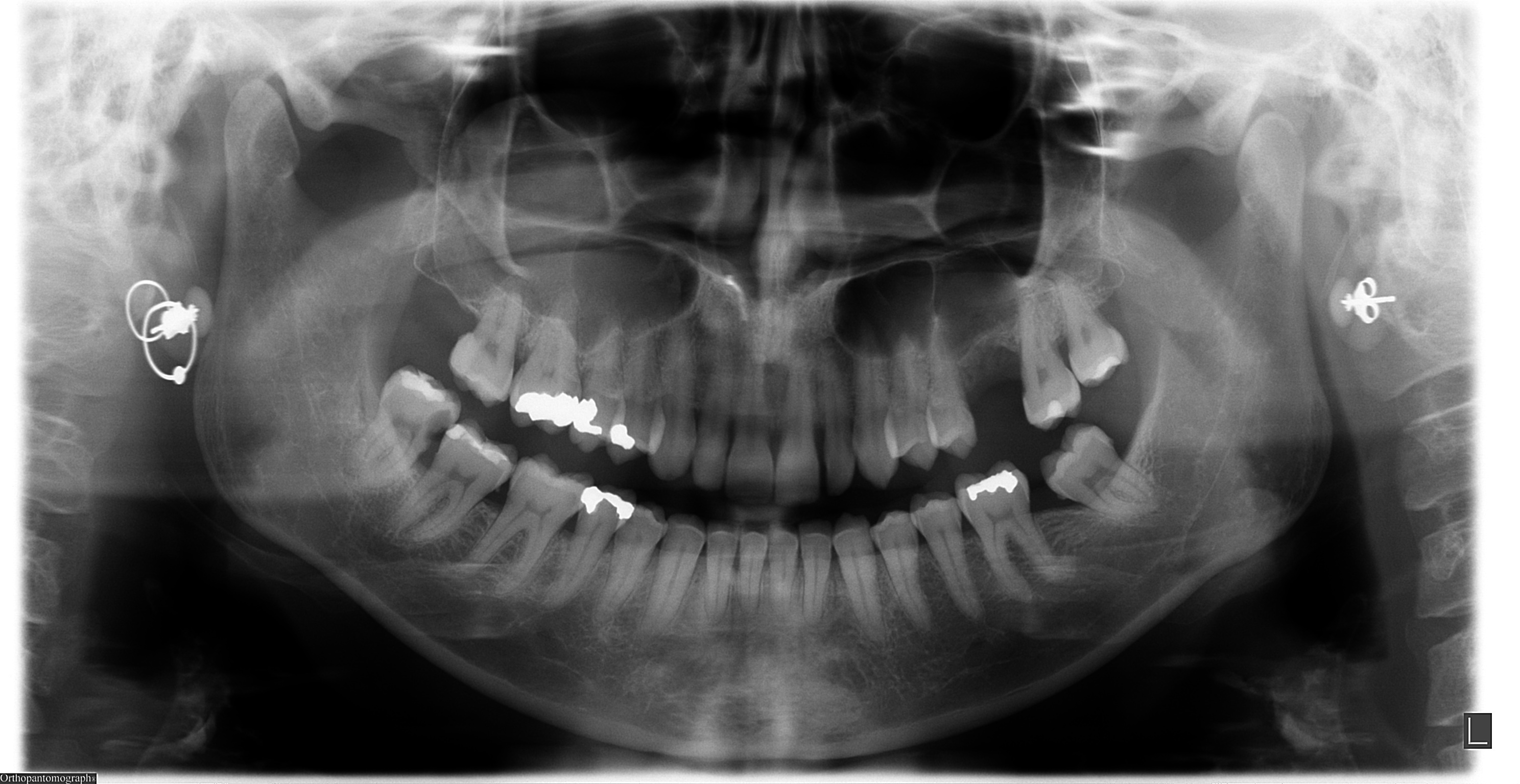 Mi hanno trovato una bella carie nel dente del giudizio