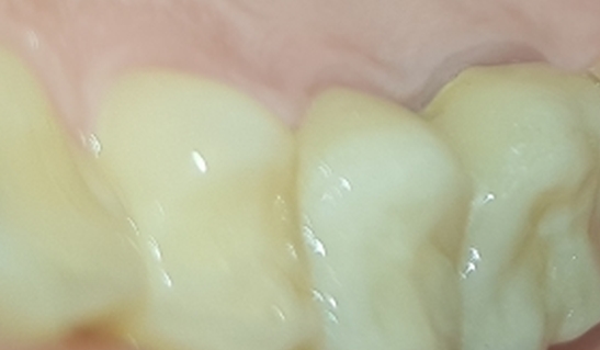 capsula-in-zirconia.jpg