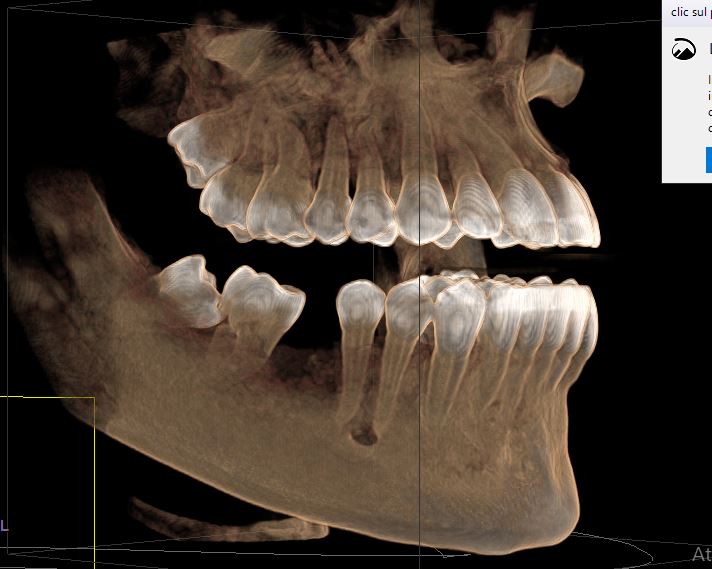 Il dente risulta cariato a causa del dente del giudizio adiacente?