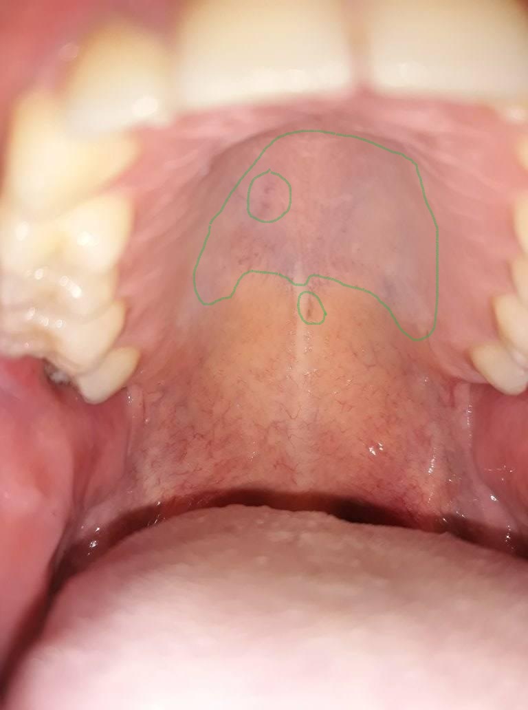 Papilloma del palato. Virus y cavidad oral: Virus del Papiloma Humano abdominal cancer discomfort