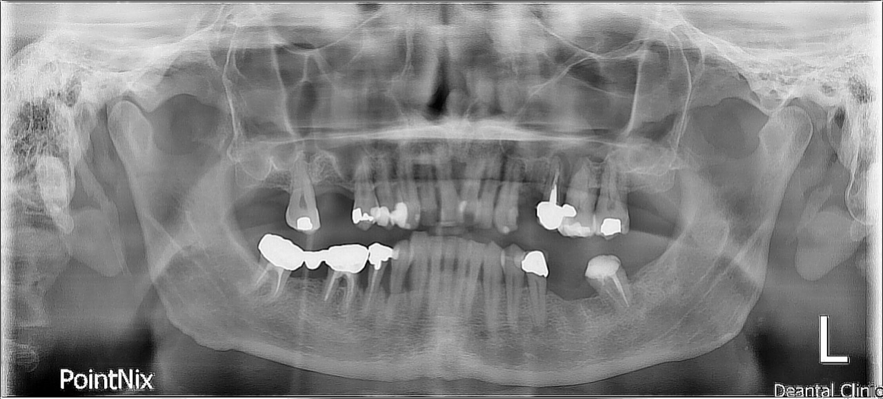 A seguito dell'estrazione del dente 25 mi hanno giustamente richiesto una Tac