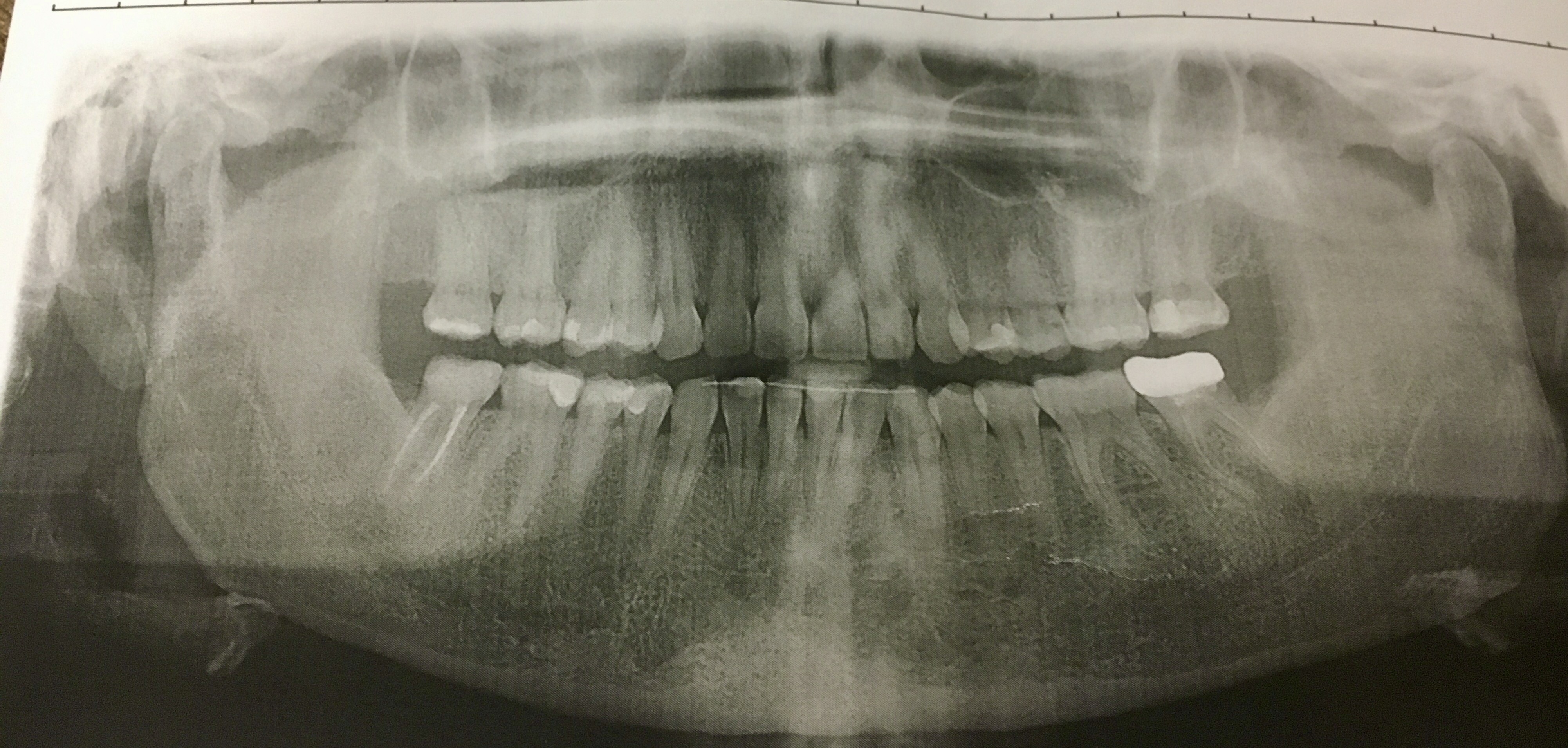 PerchÃ© il granuloma non passa?