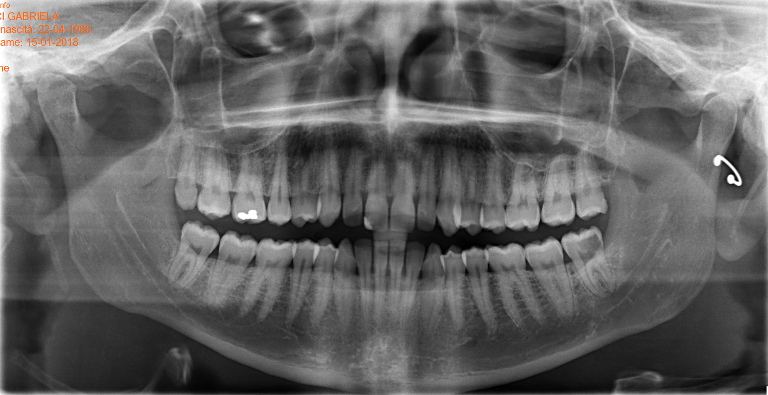 E' necessaria l'estrazione del dente o posso aspettare?