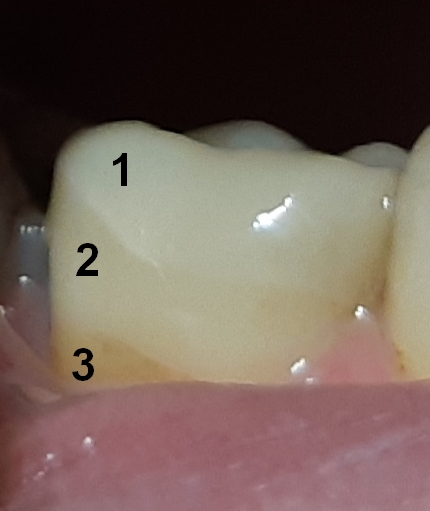 A cosa puÃ² essere dovuta la differenza di colore dell'intarsio?