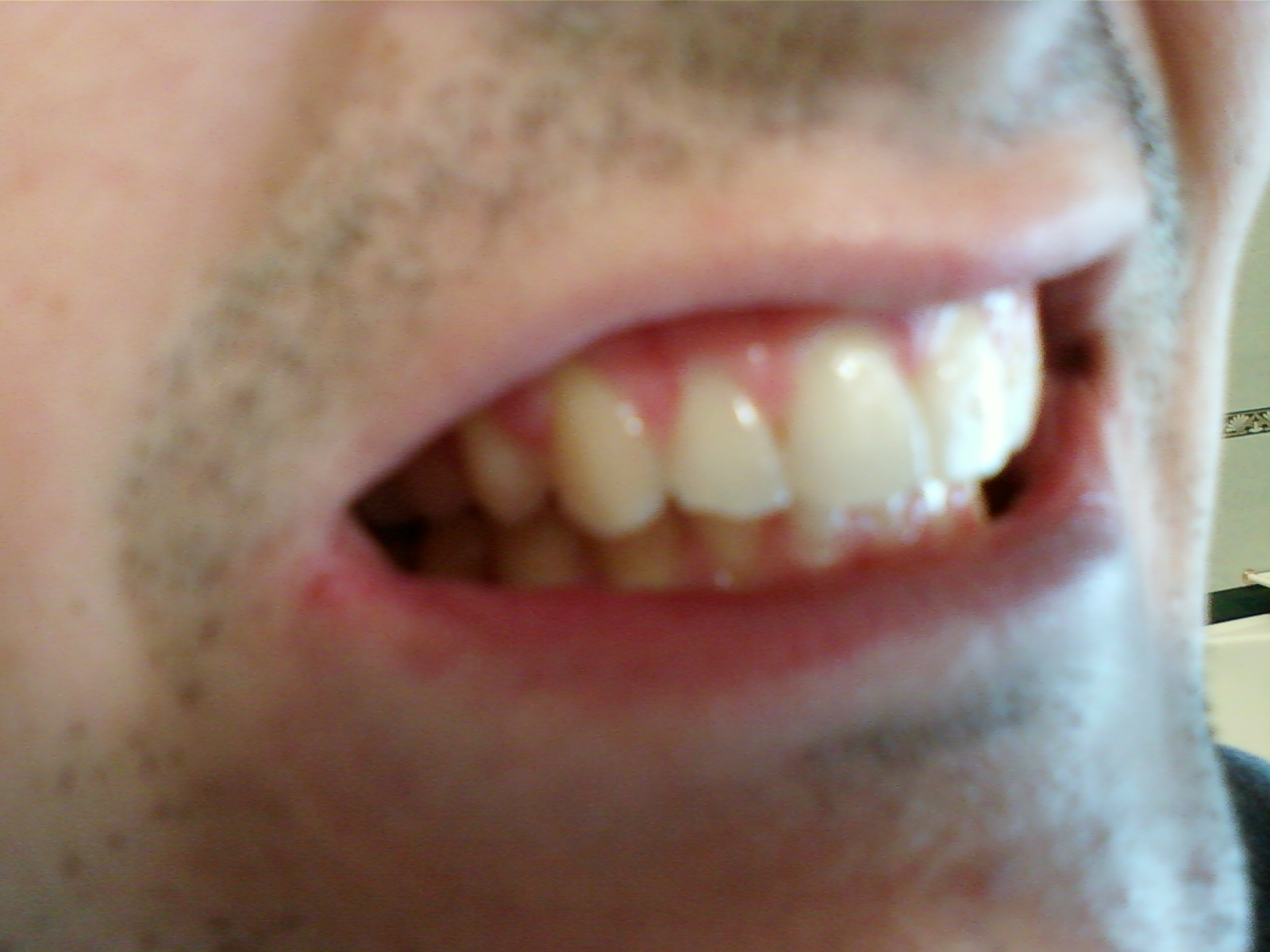 Dopo due anni di trattamento ortodontico, non sono soddisfatto del risultato