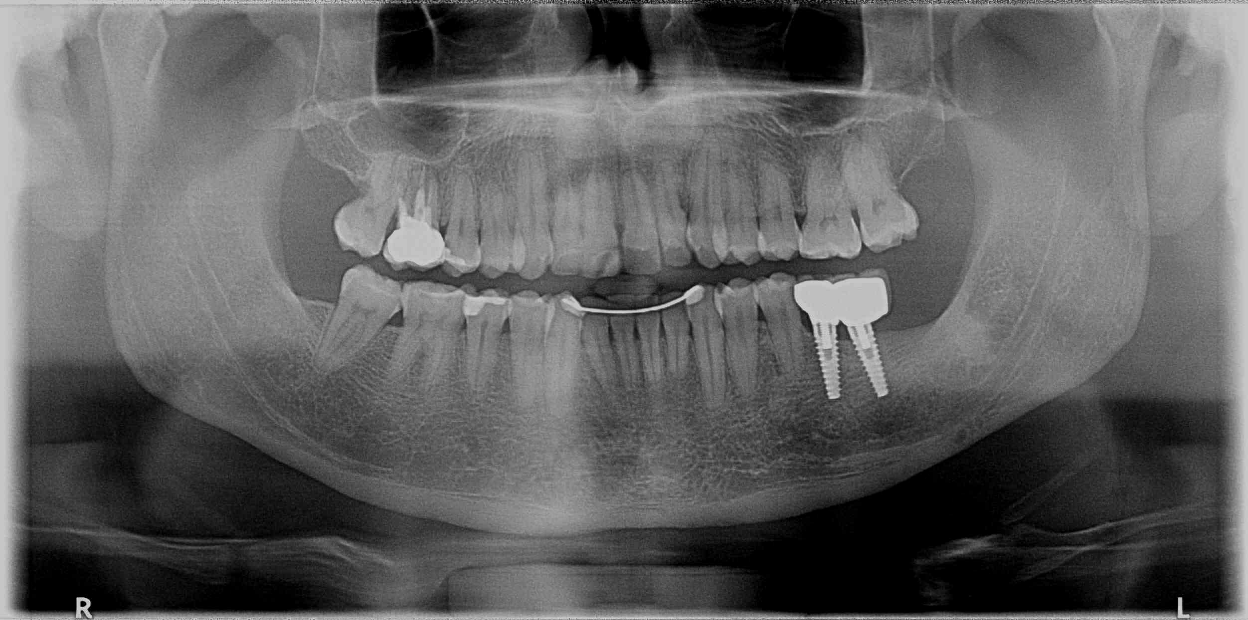 Mi è stata diagnosticata una seconda tasca gengivale