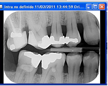 Vorrei la vostra opinione sul tema del dente devitalizzato come focolaio di infezione