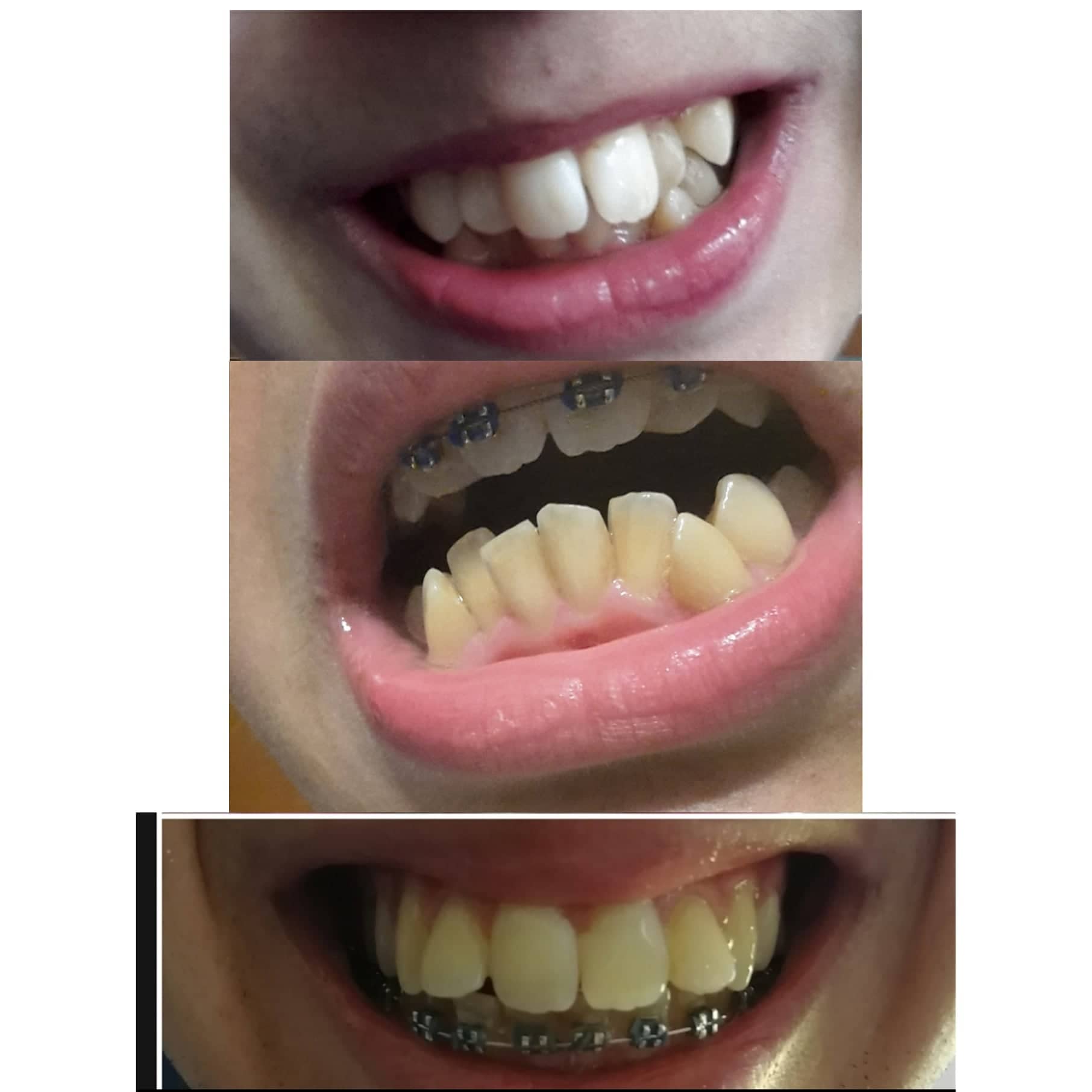 Ho sentito parlare di propulsori mandibolari, potrebbero fare al caso mio?