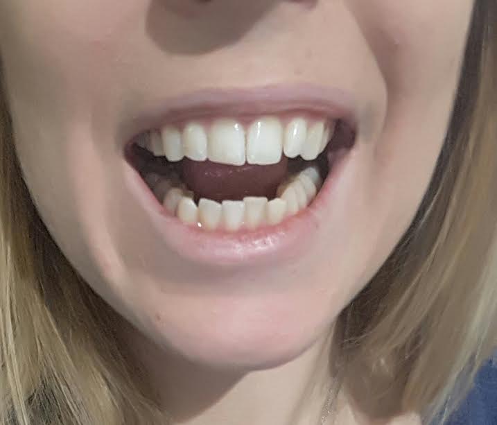 denti2cf.jpg