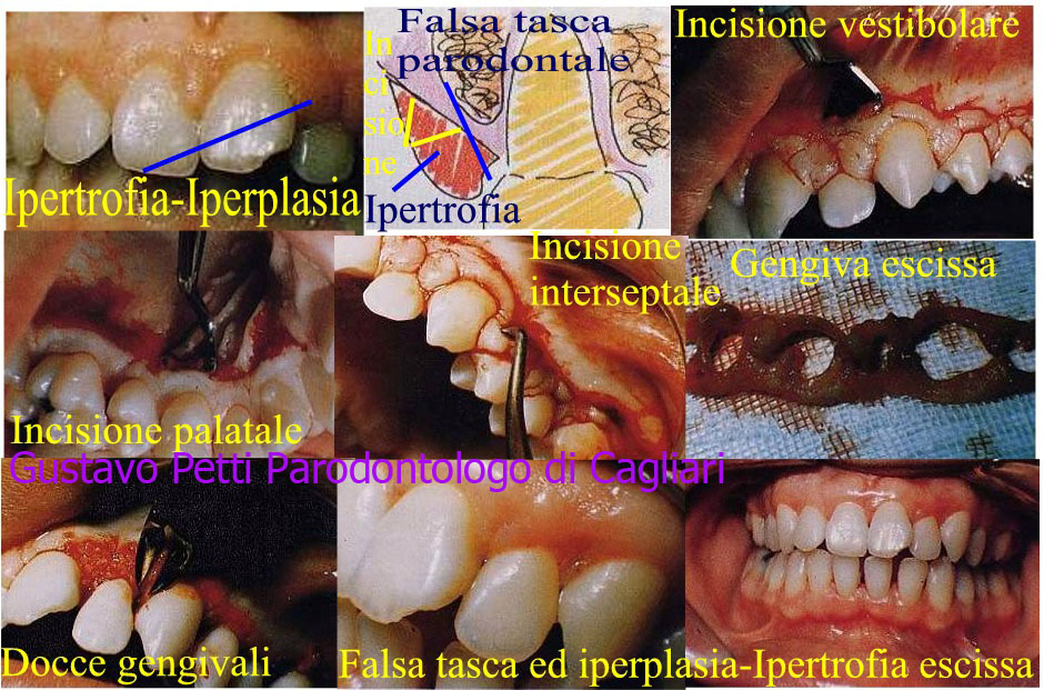 dr.-gustavo-petti-gengivectomia-191.jpg