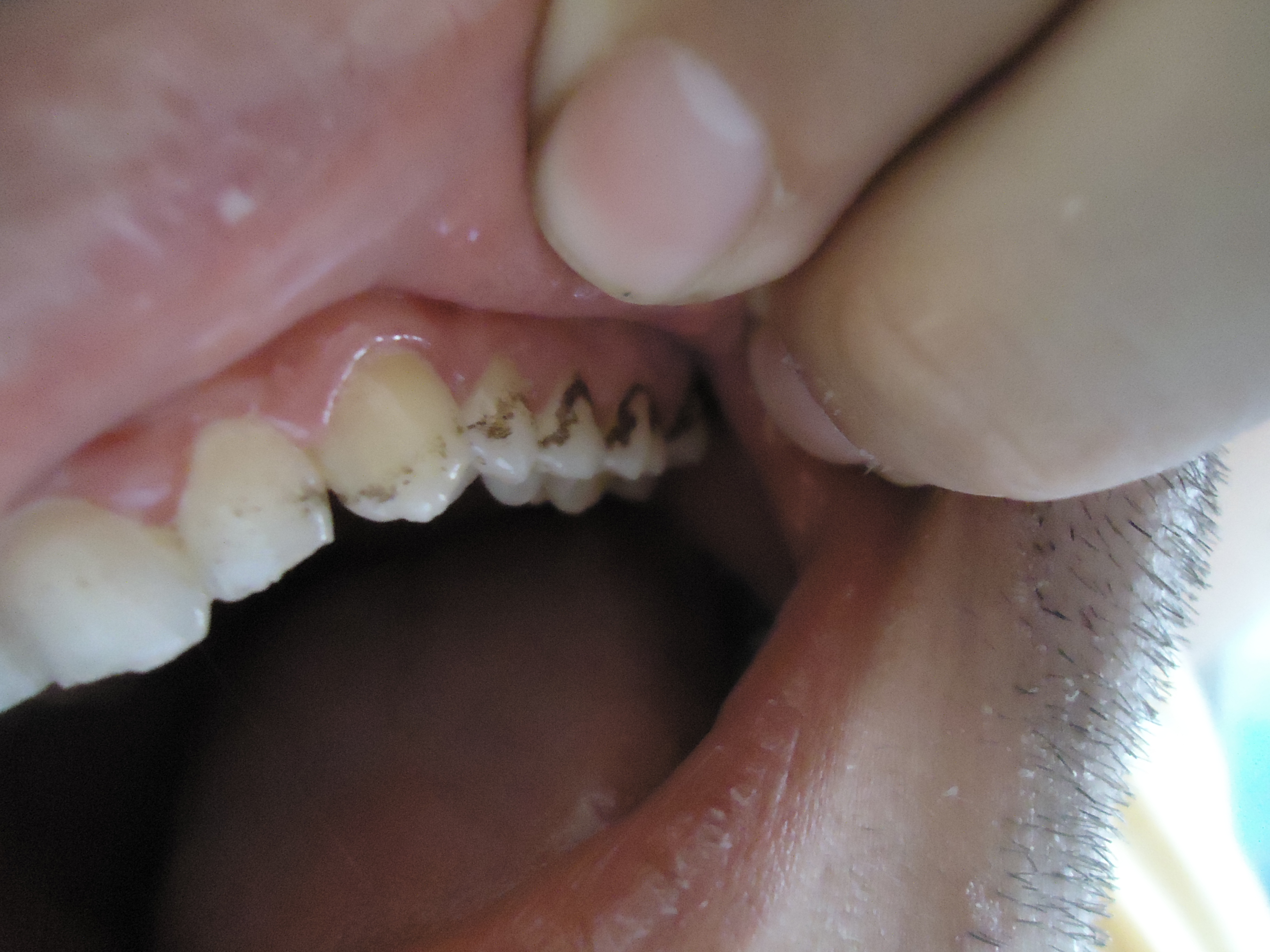 Ho notato che nei denti sia superiori che inferiori si sono formate delle macchie nere