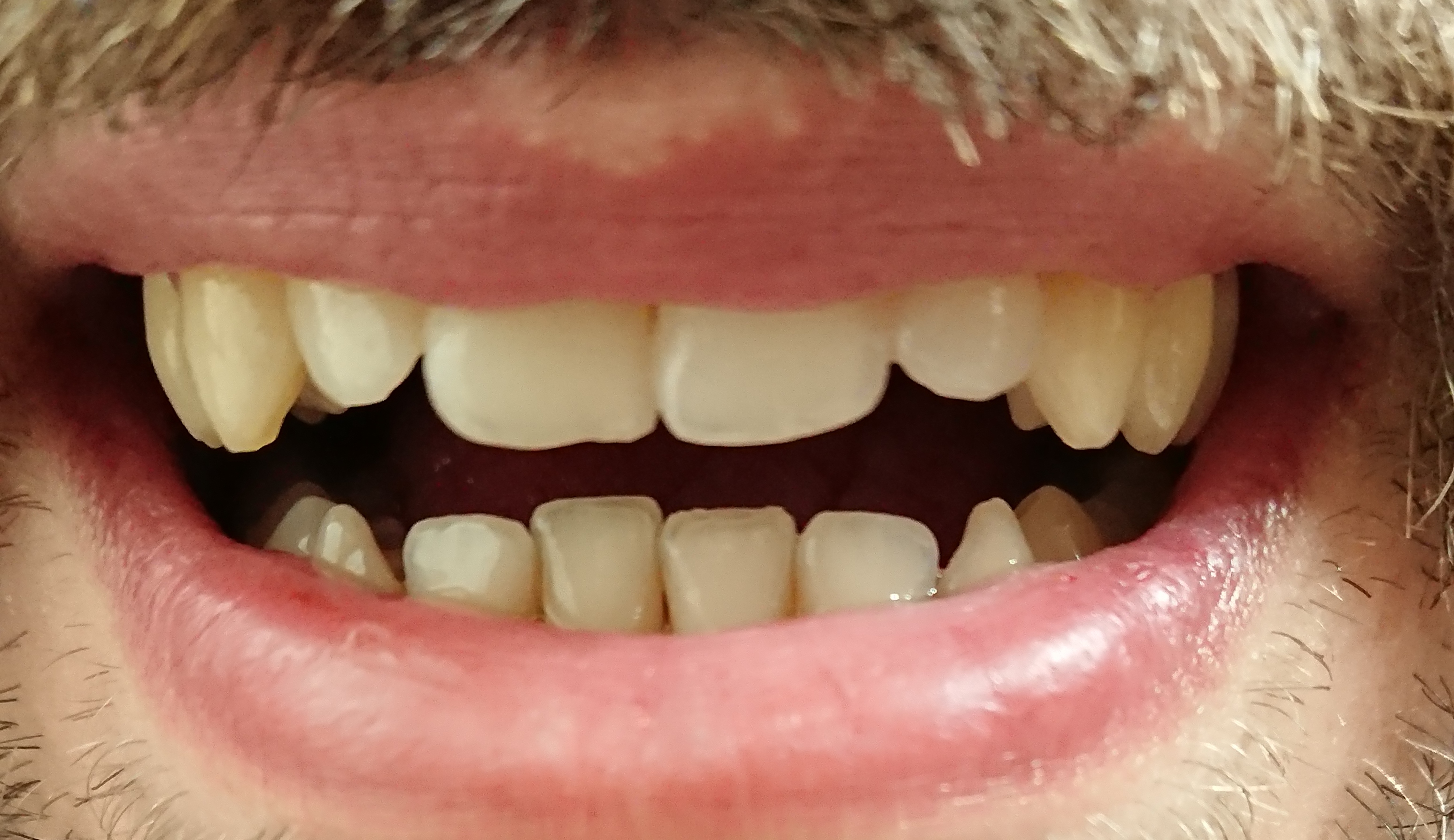 Qualche mese fa mi sono scheggiato un dente incisivo mentre mangiavo