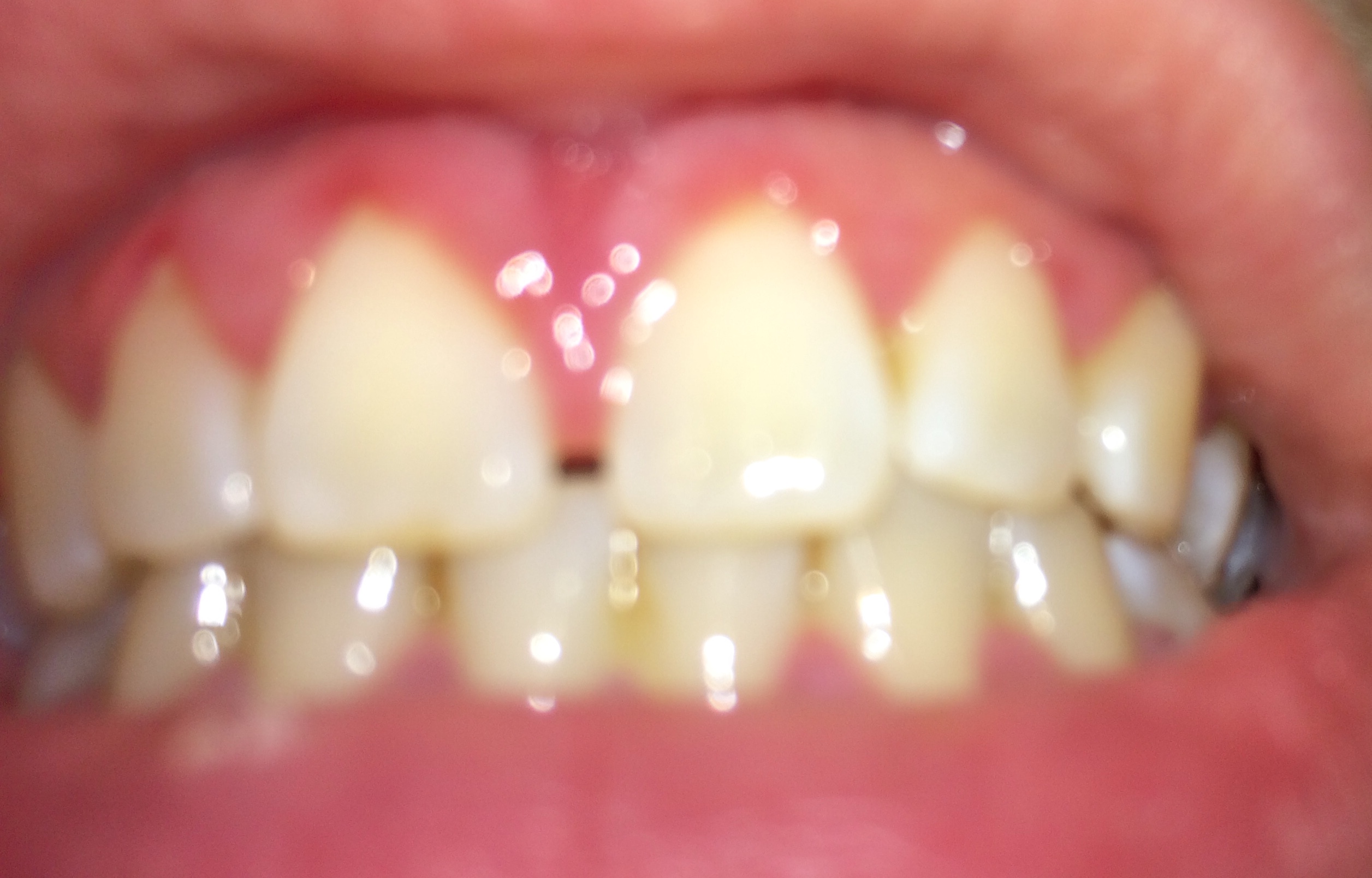 Gengiva gonfia tra i denti incisivi