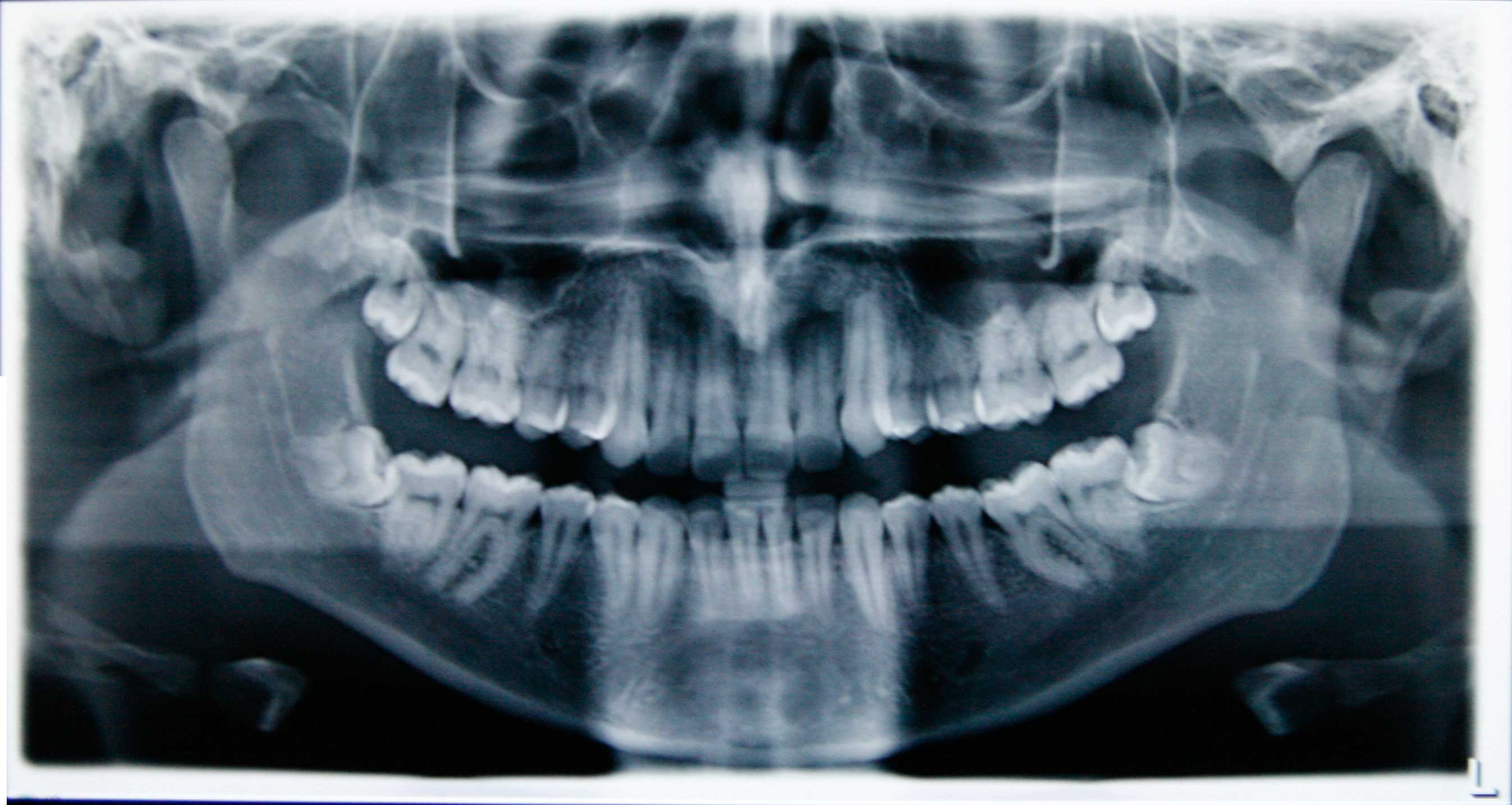 E' possibile che il dolore e l'infiammazione agli incisivi superiori siano causati da un dente del giudizio?