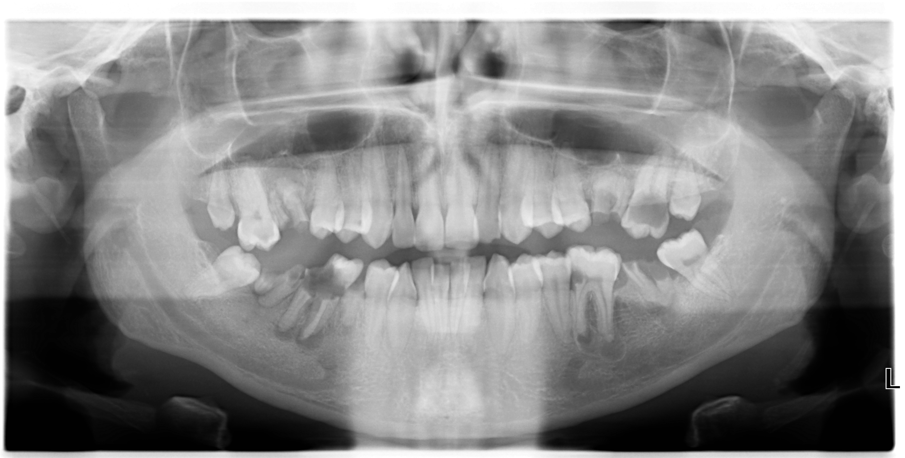 Ho 12 denti da togliere compresi quelli del giudizio