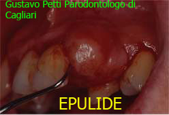 epulide-dr.g.petti-parodontologo-cagliari9.jpg