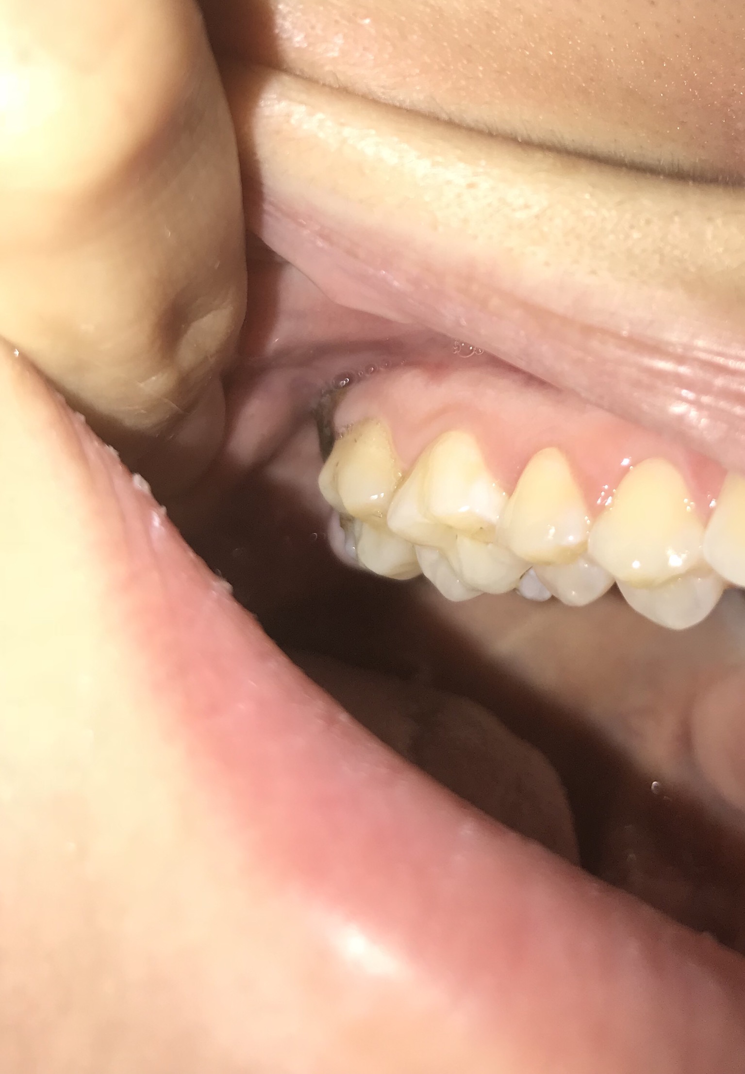 Seguito alla domanda: Problemi dopo l'estrazione del dente del giudizio superiore