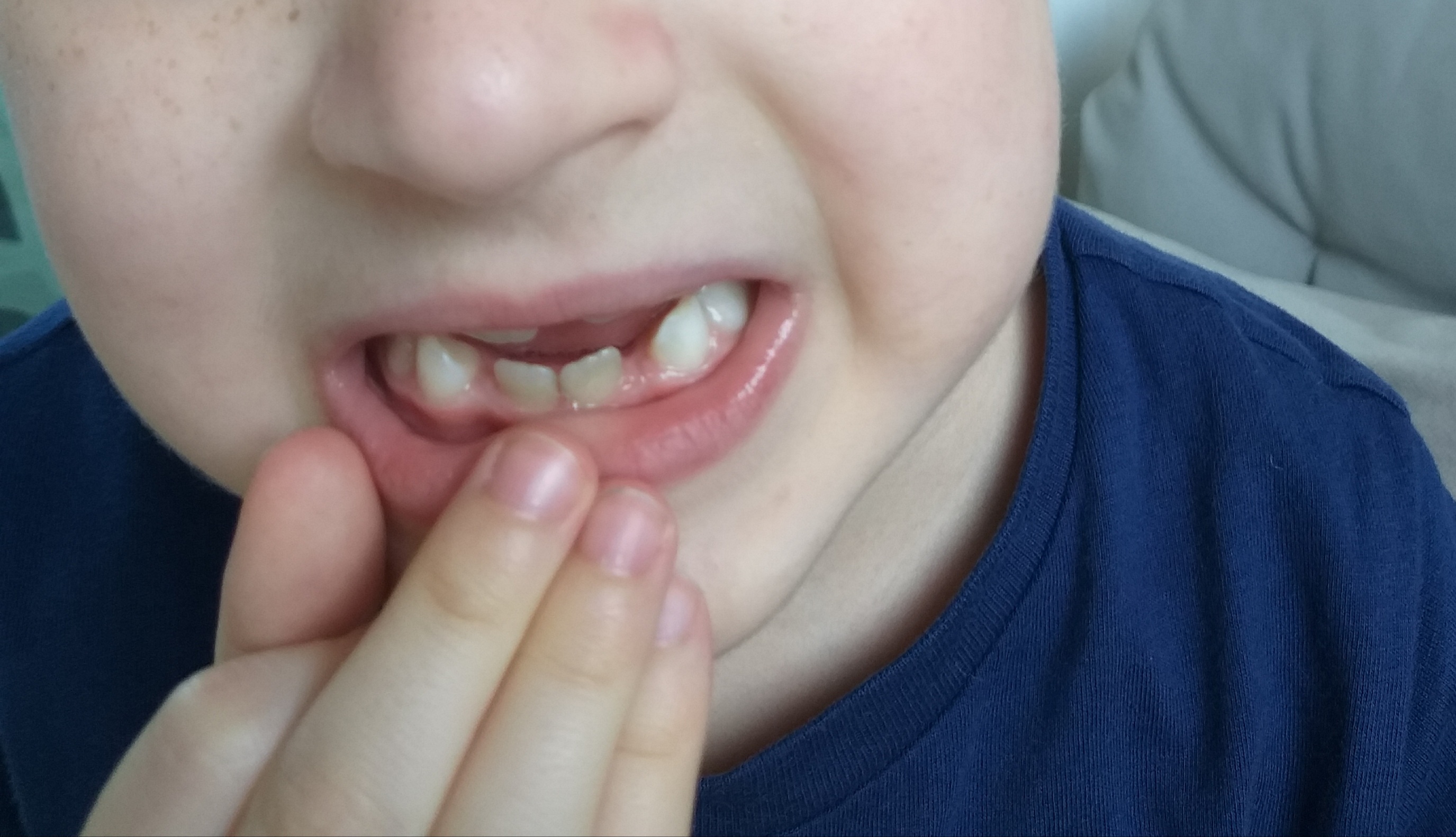 Colore denti bambino di 6 anni