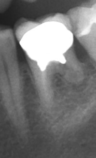Il dentista mi ha diagnosticato un granuloma al molare