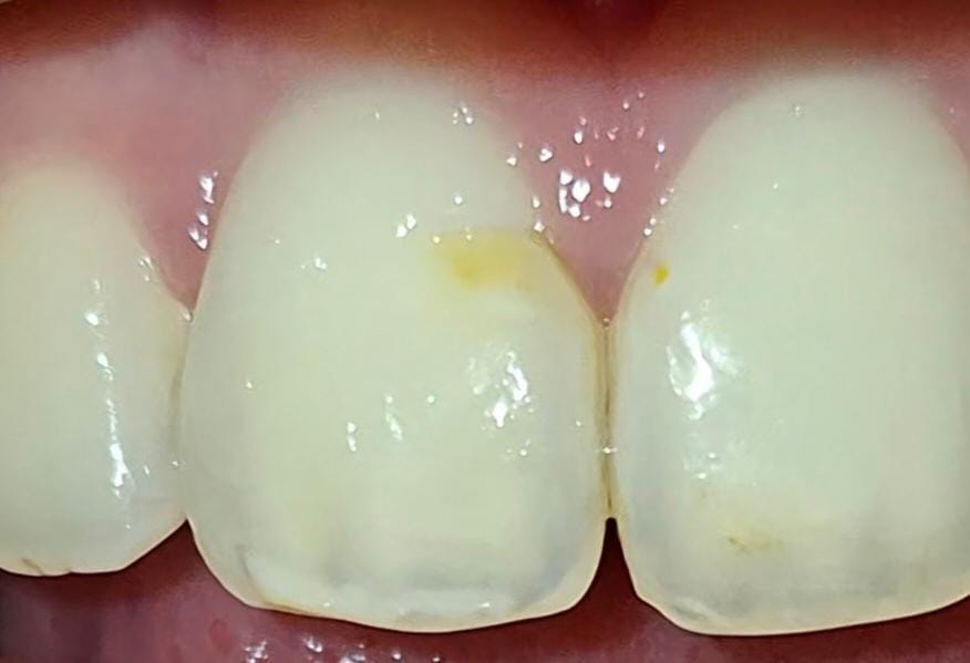 Taglietto sull'incisivo dopo apparecchio e bite: cosa puÃ² essere?