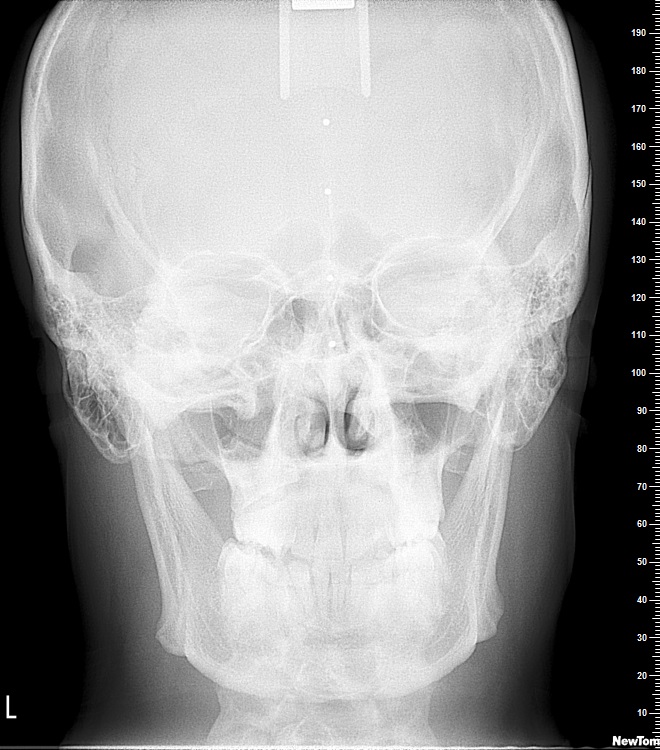 Malocclusione di seconda classe dentale piÃ¹ morso crociato monolaterale sinistro