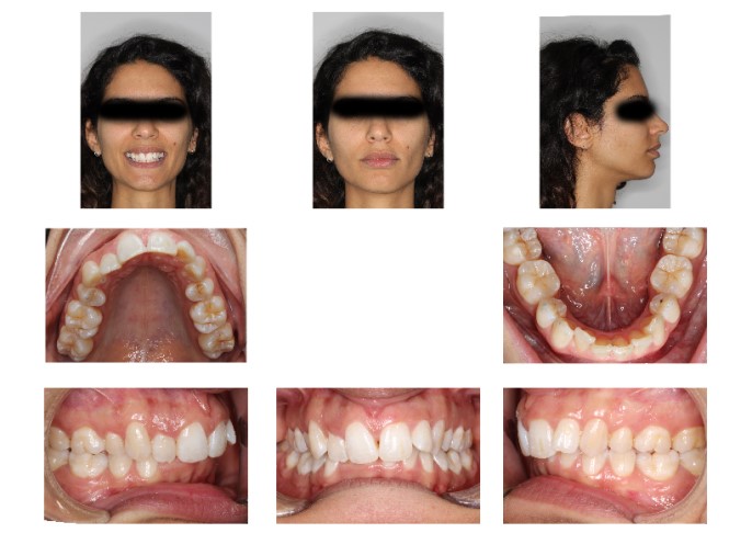 Dopo sei mesi di Invisalign ho notato dei cambiamenti non piacevoli nella parte inferiore della faccia.