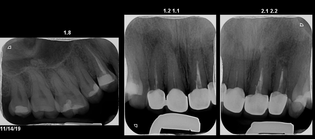 Da qualche mese sento dei dolori ai denti davanti e all'ultimo dente di sopra