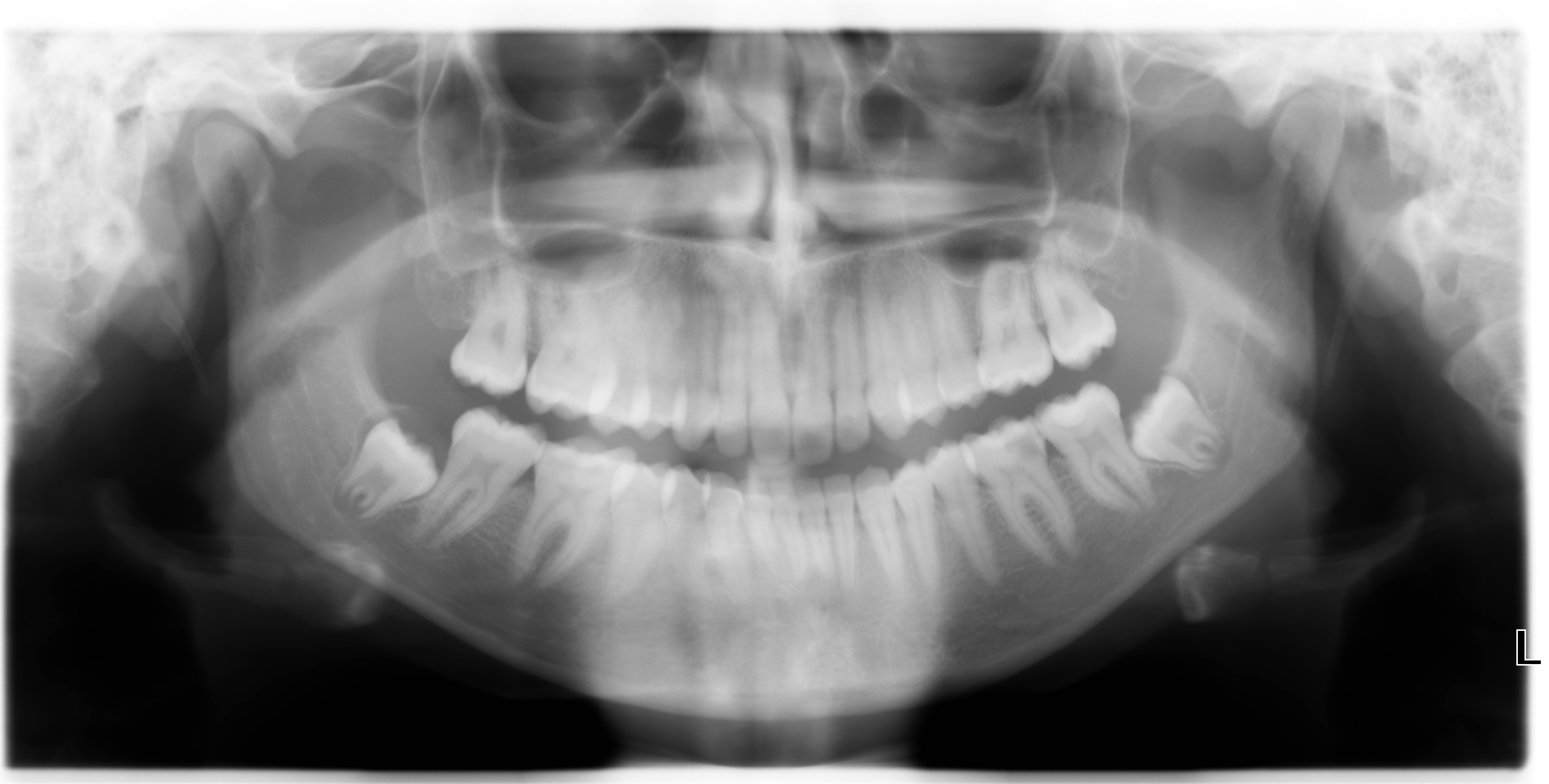 Il mio dentista mi ha suggerito di dover togliere i denti del giudizio