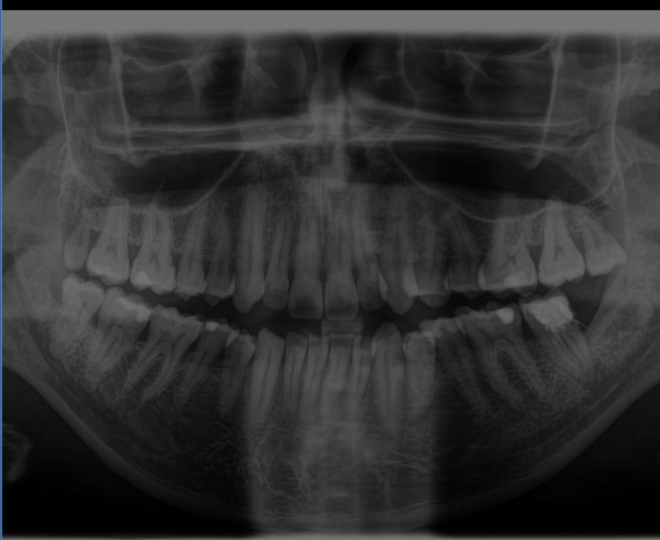 Osteorarefazione peri-apicale