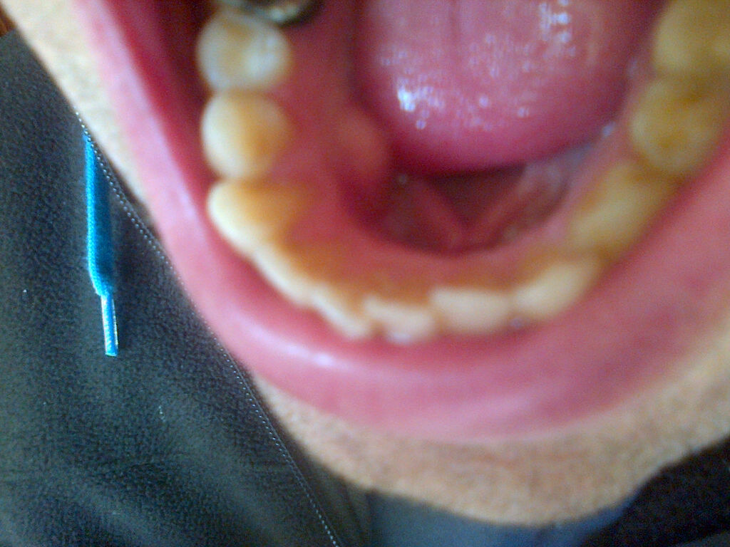 Mi è stata diagnosticata in bocca, lato gengivale una espansione ossea.
