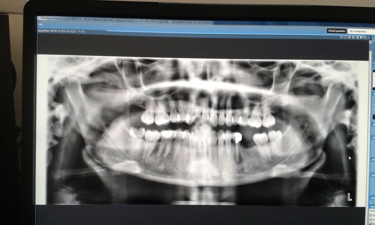 A breve dovrÃ² seguire estrazione del dente del giudizio inferiore destro cariato e necrotico