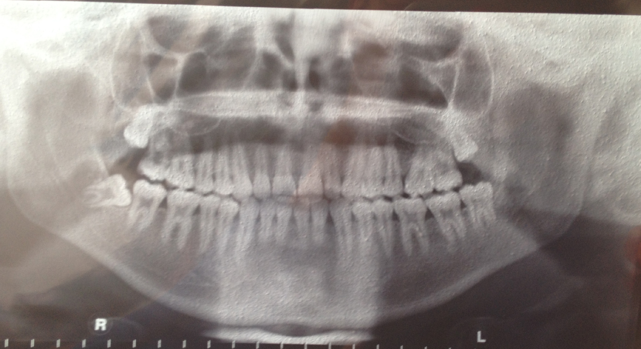 I denti del giudizio danno questi sintomi?