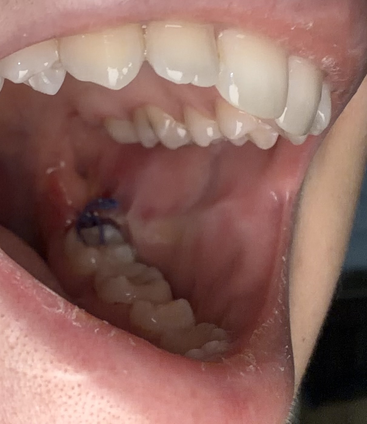 Estrazione dente del giudizio: dolore e bruciore dopo 5 giorni