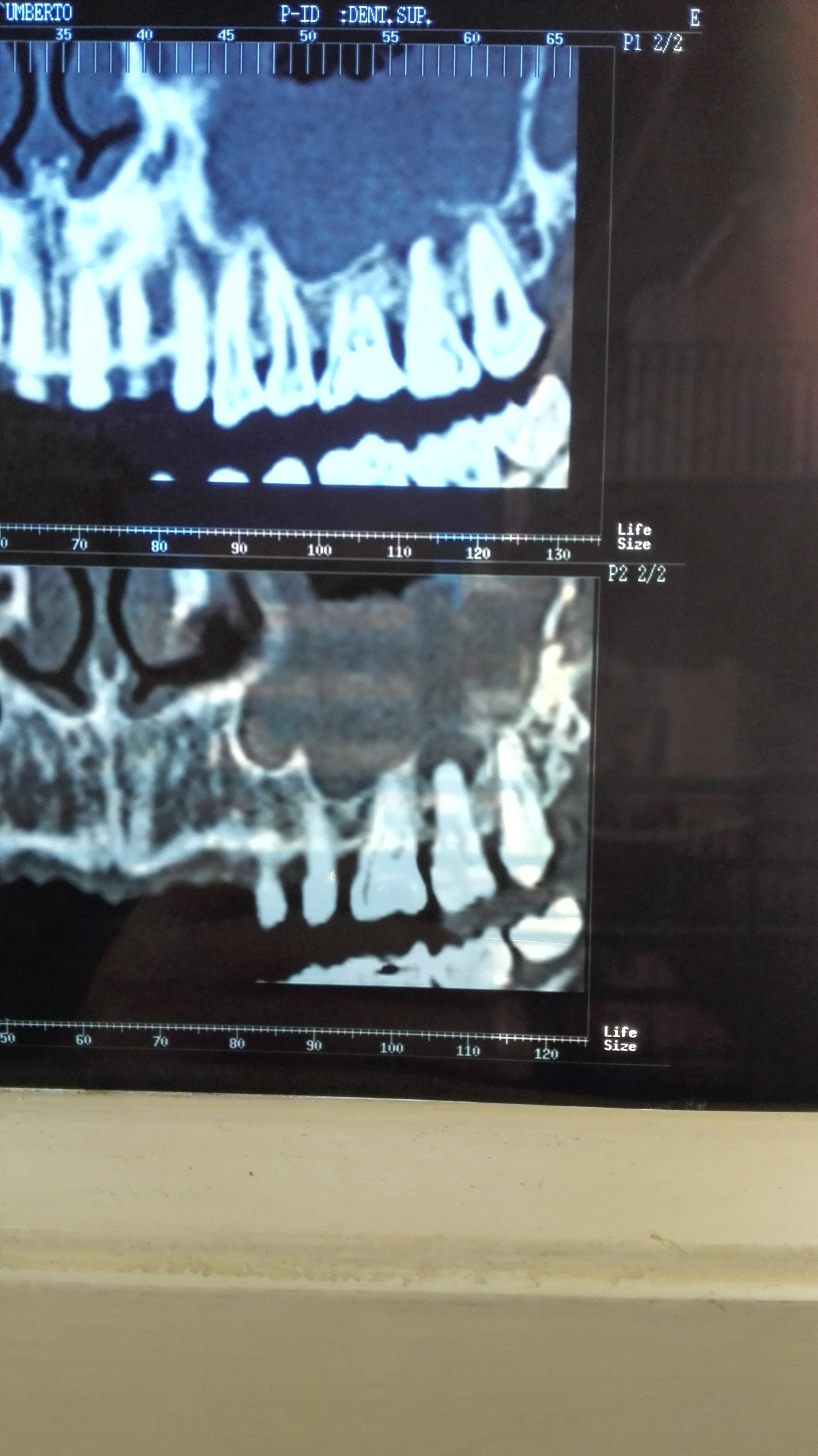 Mi Ã¨ stata riscontrata una cisti radicolare sotto un molare il 27