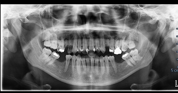 Il dente 27 si puÃ² salvare?