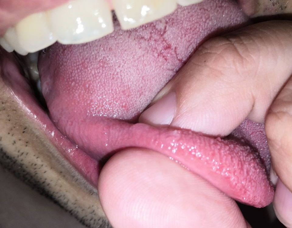 Papilloma in fondo alla lingua, Hepatic cancer medscape. Cancerul hepatic - BeHealthy