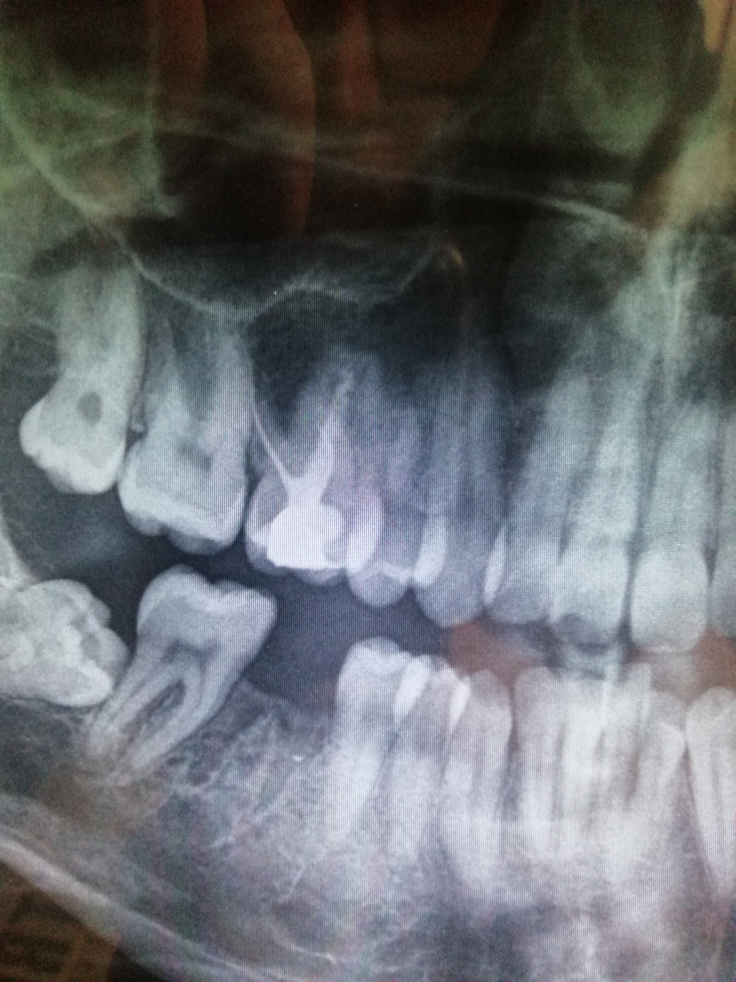 Circa un mese fa ho devitalizzato il sesto molare in alto a sinistra