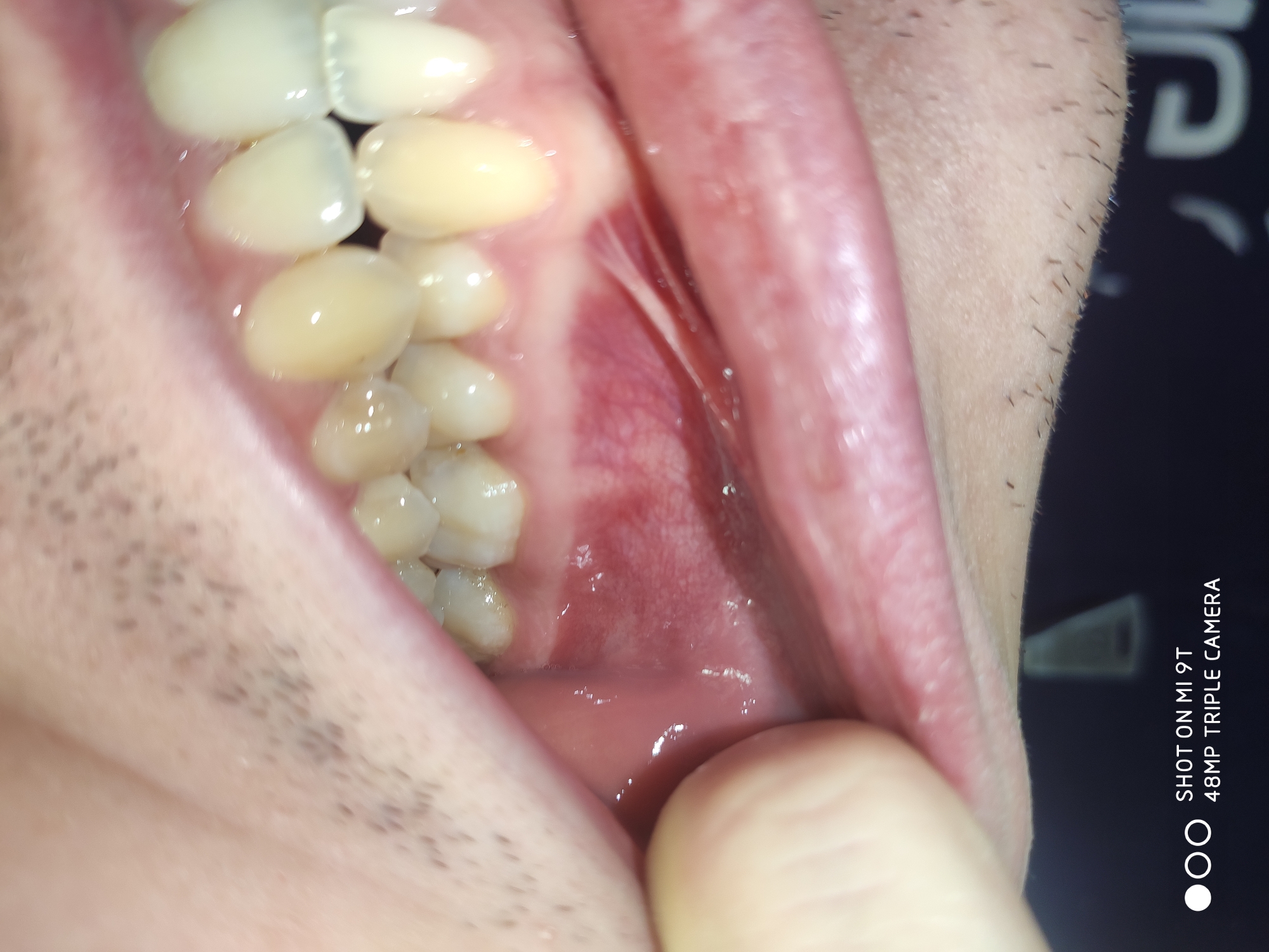E' normale quel rigonfiamento bianco sotto al dente 46?