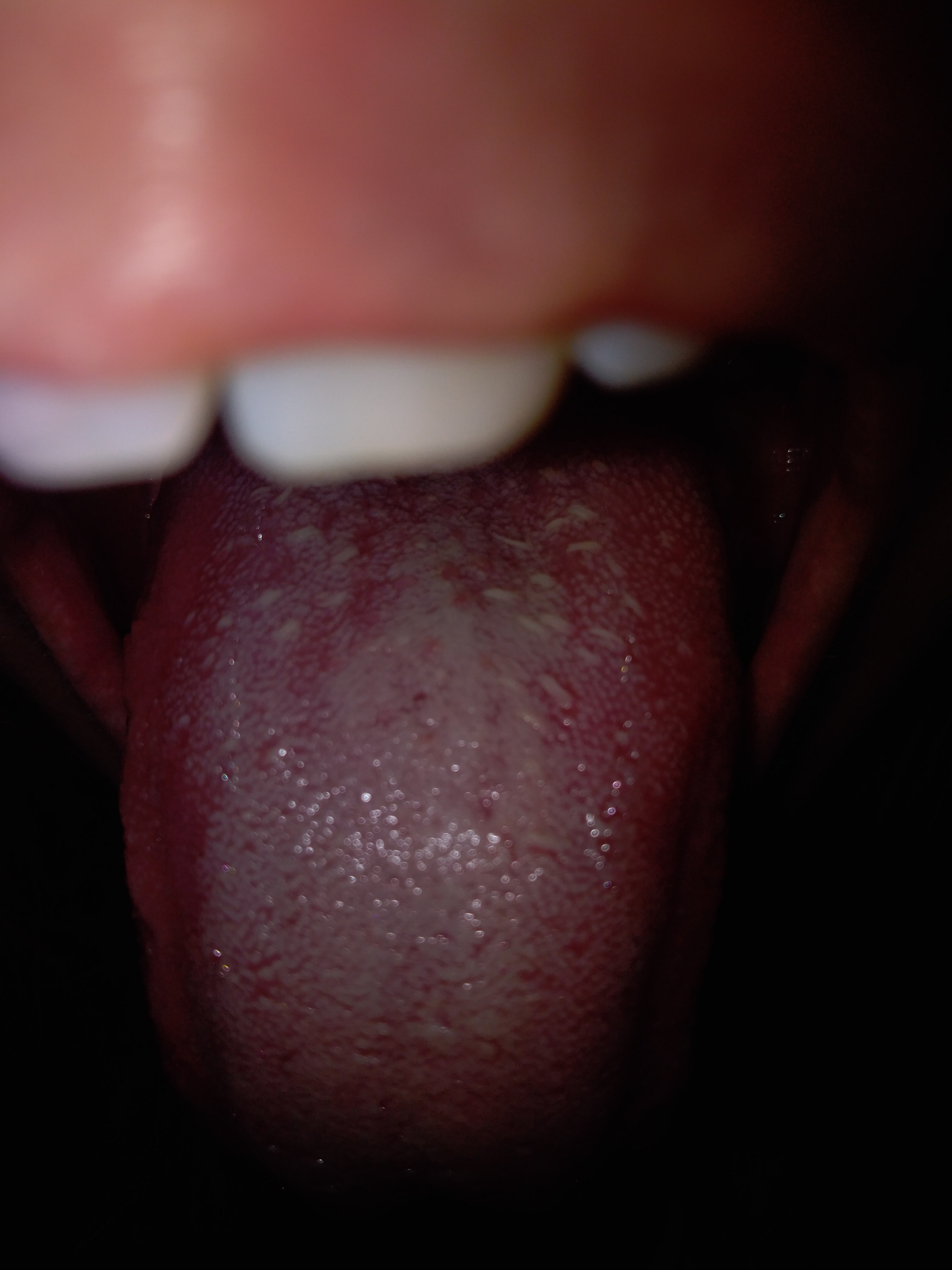 Papilloma dorso lingua, Papillomavirus bocca lingua. Papilloma virus bocca lingua