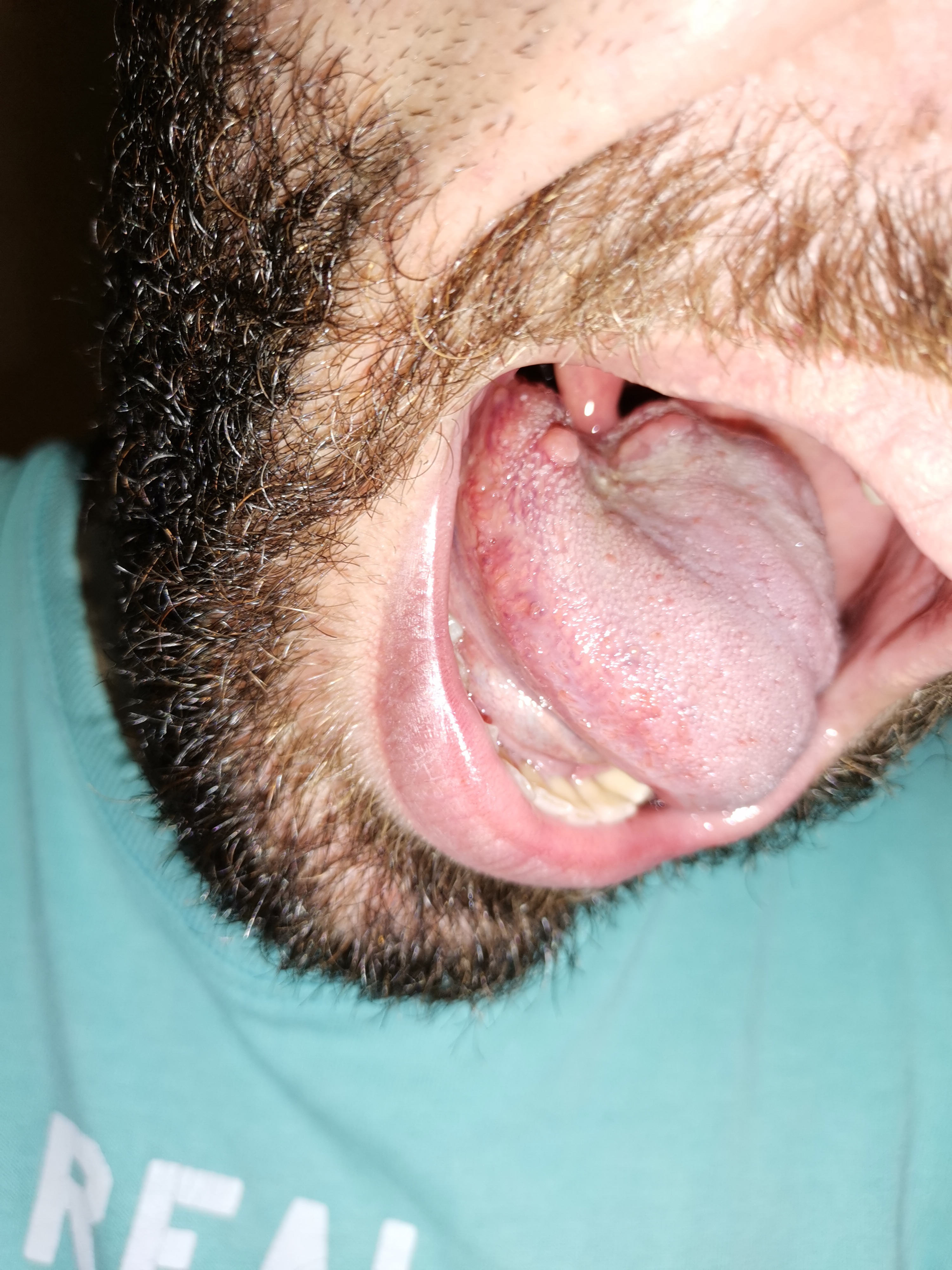 Patina bianca sulla lingua